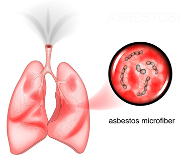 Illustration of asbestos microfibers and human lungs.