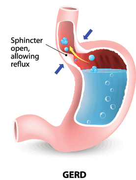 Illustration of gastroesophageal reflux disease.